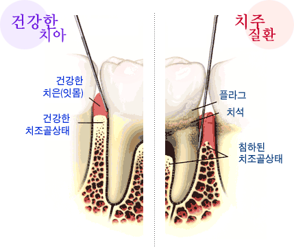 치주질환의 원인은 무엇인가?