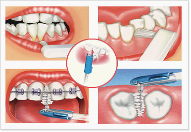 치간치솔(interdental brush)